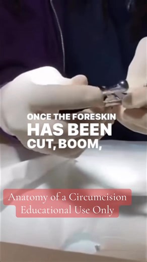 The torture of American men became assembly line with Goldstein's invention the Gomco clamp in 1935. Infants are never told of their suffering, they learn it in locker-rooms & playgrounds. Sociologists ignore the question: What's this mass mutilation of men done to our nation? #circumcision | Bloodstained Men & Their Friends