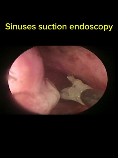 Sinuses suction endoscopy #sinuses #sinusrinse #suction #endoscopy #satisfyingvideo #fyp