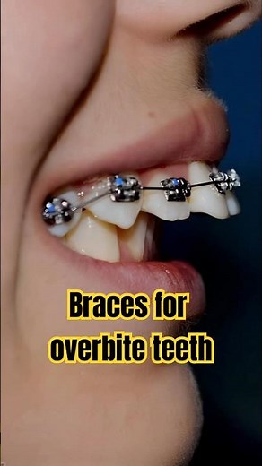 Braces for overbite teeth transformation #braces #orthodontist #dentist