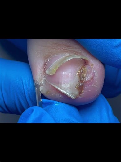 Easily cut off ingrown nails~ #nails #satisfying