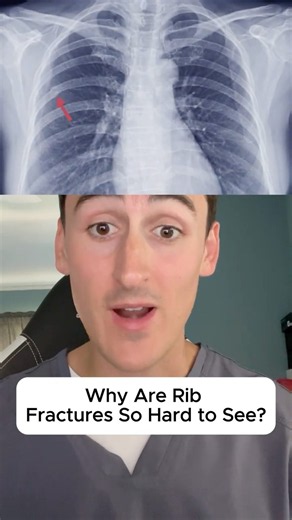 Why Are Rib Fractures So Hard to See?