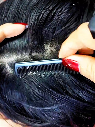 Very huge dandruff scratching #DandruffScratching #ItchyDryScalp #HugeFlakes #Dandruff #dandrufftreatment #satisfying #dandruffremoval Disclaimer: Videos do not show original Dandruff, they are used for education purpose. Thank You,,,, | The Filmy