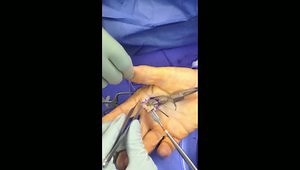 Dorsal Capsule Interposition Arthroplasty of the Metacarpophalangeal Joint