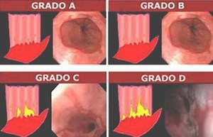 Que Es Esofagitis Erosiva Clasificacion De Los Angeles A