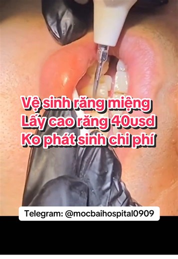 Vệ sinh răng miệng, lấy cao với bác sĩ hơn 30 năm kinh nghiệm nha khoa tại Bệnh viện nhân dân Bavet #vesinhrangmieng #laycaorang #洗牙 #bavet #巴韦