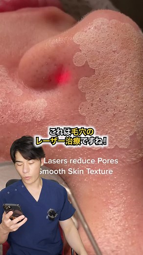 レーザーで肌がカサブタだらけに？！ツヤ肌毛穴治療#あきよし先生 #laser #lasertreatment #acne #acnetreatment