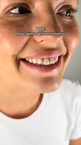 Your gums before veneers. Prep the after 🤩 #veneers #veneer #gums #smilemakeover #cosmeticdentist | JoycetheDentist
