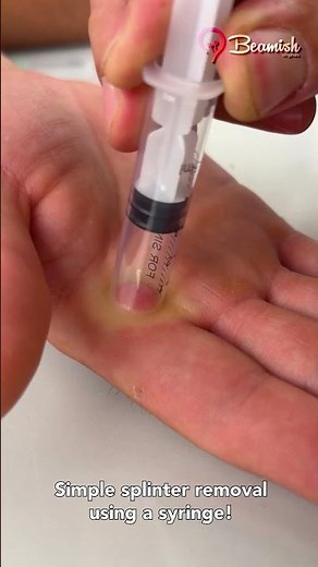 Simple splinter removal using a syringe! #simple #remove #splinter #syringe
