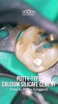 Putty-type Calcium Silicate Cement