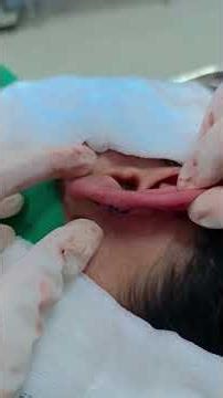 ear dermoid cyst surgery #sialkot #pakistan