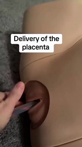 105K views · 255 reactions | Delivery of the Placenta practically demonstrated | Brilliant Midwives | Facebook