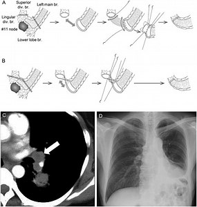 Extended bronchoplasty for locally advanced left lower lobe lung cancer: surgical technique and outcomes†
