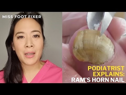 RAMS HORN TOENAILS | Trimming Extremely Long and Thick Toenails | Toenail Fungus | Miss Foot Fixer