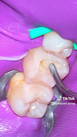 Vital Pulp Therapy: I am showing the treatment of a mandibular first molar with the diagnosis of irreversible pulpitis. You will see that a full pulpotomy was the treatment of choice in this case, with the surgical procedures brought to the level of the orifices. You will notice that, after removal of the roof, the pulp tissue in the chamber, although partly vital, appeared detached from the pulp chamber walls. There is histological evidence that this clinical feature is associated with severe i
