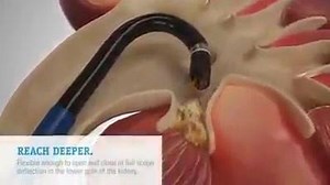 Kidney Stone removal surgery | I Love Medical Profession