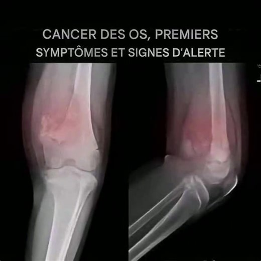 Cancer des os : symptômes et signes avant-coureurs à ne pas ignorer. | Bravo au Personnel Médical | Facebook