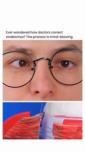 23K views · 57 reactions | Strabismus isn’t just a “lazy eye” or...