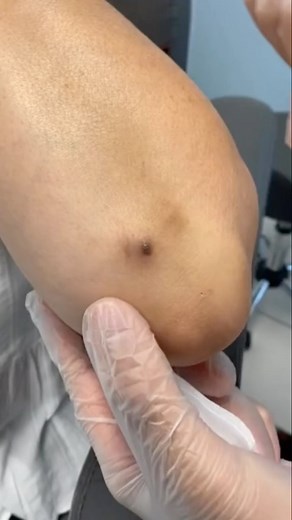 pimplepopping.tv on Instagram: "Massive elbow surprise  . . . : #pimple #pimplepopping #pores #pimplepop #pimples #acne #blackheads #whiteheads #blackheads #blackheadremover #blackhead"
