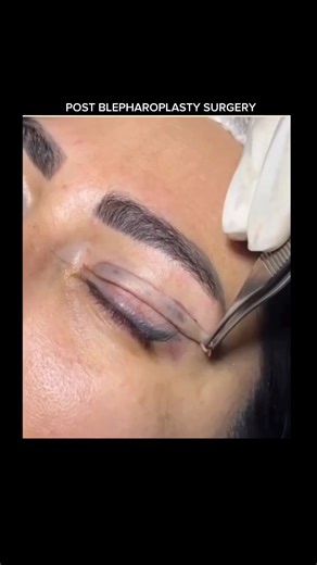 Explaining Biology on Instagram: "POST BLEPHAROPLASTY (Eyelid Surgery) ✨ Blepharoplasty is a cosmetic procedure that removes excess skin and fat from the upper and/or lower eyelids to create a more refreshed, youthful look. Post-surgery, it’s normal to experience mild swelling, bruising, and tightness. Most patients see visible improvement within 7–14 days, with results continuing to refine over a few weeks. Proper aftercare—cold compresses, rest, and following your surgeon’s instructions—helps