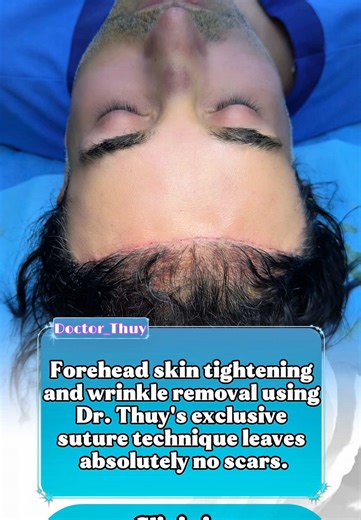 Forehead Lift and Hairline Reduction Procedures Explained