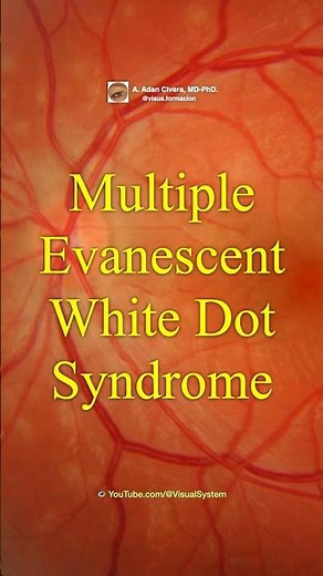 Multiple Evanescent White Dot Syndrome. MEWDS.