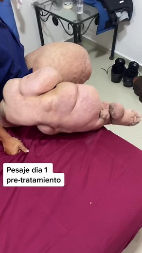 Understanding Lymphedema Treatment and Rehabilitation