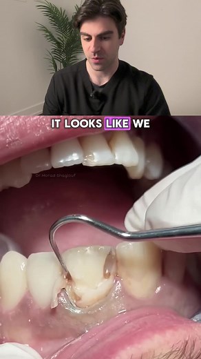 Replacing Front Filling with Composite: Dental Insights