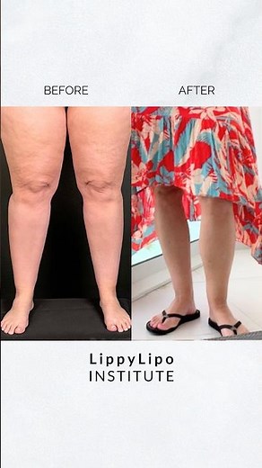 The Truth About Lipedema Legs | LippyLipo