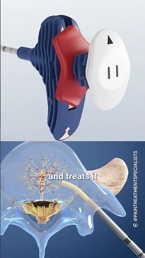 Intracept treatment for pain management