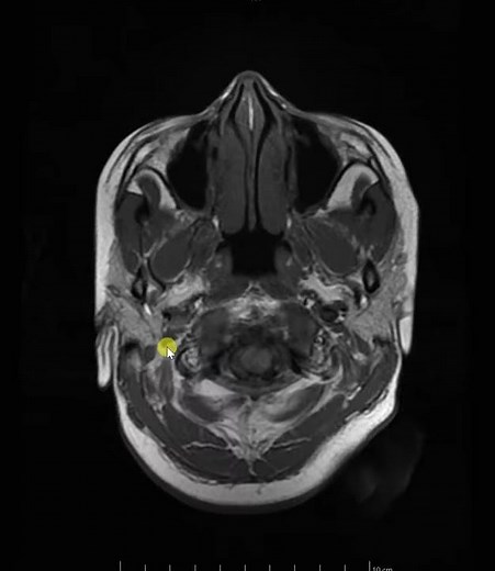 Mastoiditis with CSVT and Haemorrhagic venous infarction