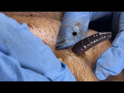 Professional Pedicure DR LEE’S ULTIMATE ZITPOPPER Sharp Ingrown Trimmed 0748