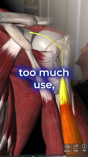 Why Your Shoulder Hurts In Front (Biceps Tendinopathy) #shoulderpain #sportsmedicine #physiotherapy