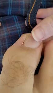 Ripped this mutant toenail thing out of my toe
