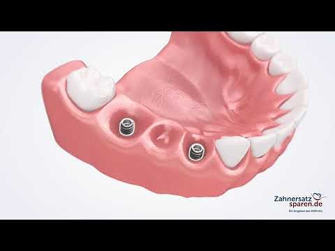 Behandlungsablauf: Verschraubte Brücke auf Implantaten - Zahnersatzsparen.de