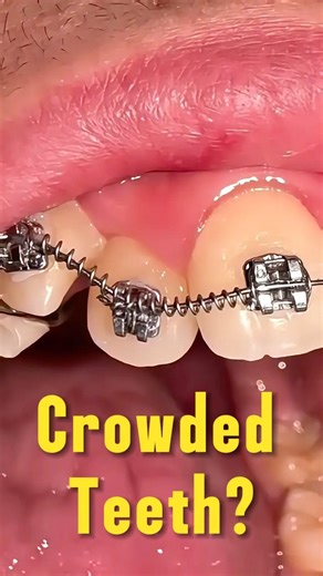 The worst part of getting braces?! 😭 #braces #orthodontist #dentist