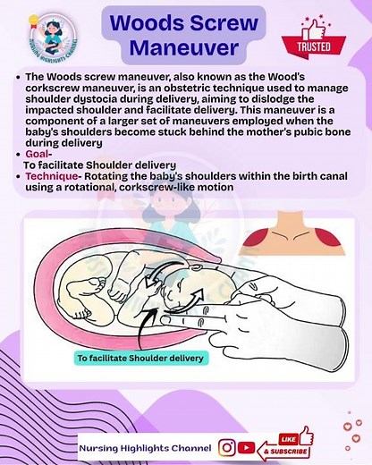 👩‍🍼Woods Screw maneuver- Used in Labour normal delivery #norcet #nursing #sgpgi #labour #aiims #obs