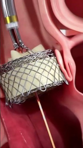 Angioplasty, angiography 3D animation video, Medical Video