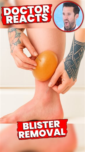Doctor ER on Instagram: "Doctor Reacts to “Satisfying” Removal of Massive Blister 😬"