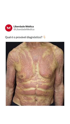 Liberdade Médica | Plantão & Paciente Grave on Instagram: "Homem de 62 anos apresenta eritema difuso e pruriginoso envolvendo mais de 90% da superfície corporal, com descamação fina e progressiva há semanas, associado a febre baixa, mal-estar e perda ponderal. Ao exame, observa-se eritroderma generalizada, linfadenomegalias palpáveis e discreta eosinofilia no hemograma. A biópsia cutânea mostra infiltrado perivascular rico em eosinófilos, sem critérios de linfoma cutâneo primário. A investigação