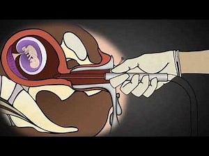 Vacuum Aspiration: for Abortion 😱😢🥺