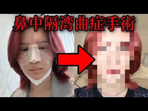 [Major surgery] His new face after repairing his deviated septum is finally revealed.