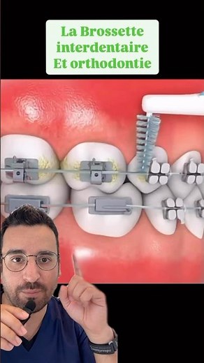 Interdental brushes and braces: the essential duo 🪥🦷