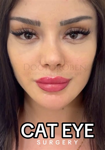 Transformative Results: 6 Weeks Post Cat Eye Surgery