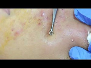 Comedone extraction for acne treatment| Blackhead removal | Twacha Skin and Hair Clinic Kochi