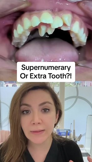 Supernumerary Teeth: Causes, Treatment, and Prevention