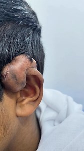 89K views · 483 reactions | Massive keloid | Dr Khaled's Tumour Helpline | Facebook