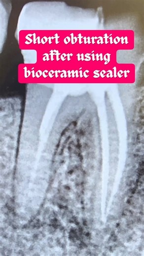 DR. AKASH MORE | ROOT CANAL SPECIALIST AND COSMETIC DENTIST on Instagram: "Bioceramic sealer didn’t betray you. Your technique did🤔🤔 Which bioceramic sealer do you use??"