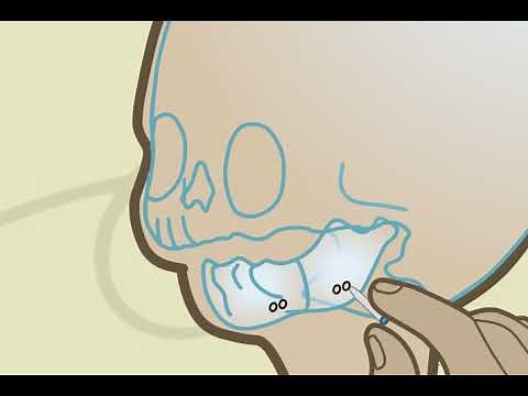 Lower jaw distraction or Mandibular distraction