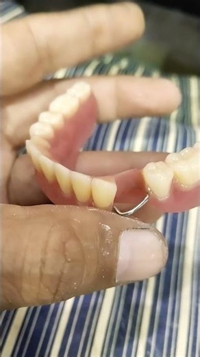Lower Removable Partial Denture 😁😁😁#rpddentalprocedure #partialdenture #viralvideo