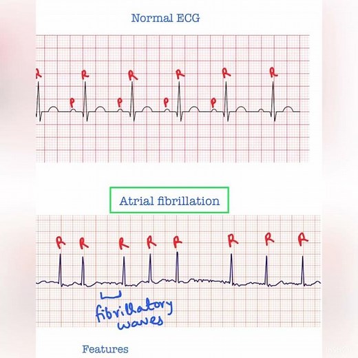 Atrial fibrillation ECG - USMLE Step 1 & 2